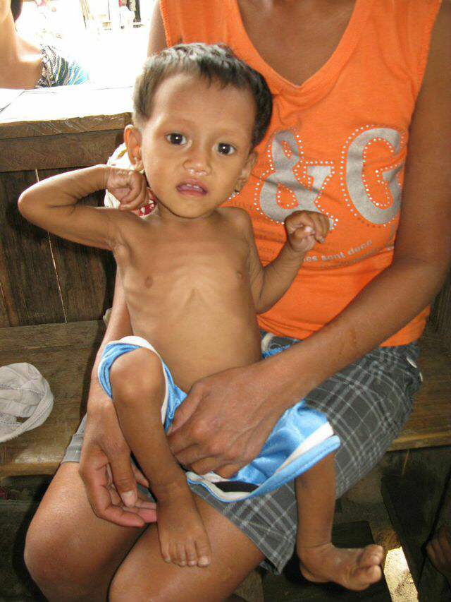 Unterernährung Philippinen